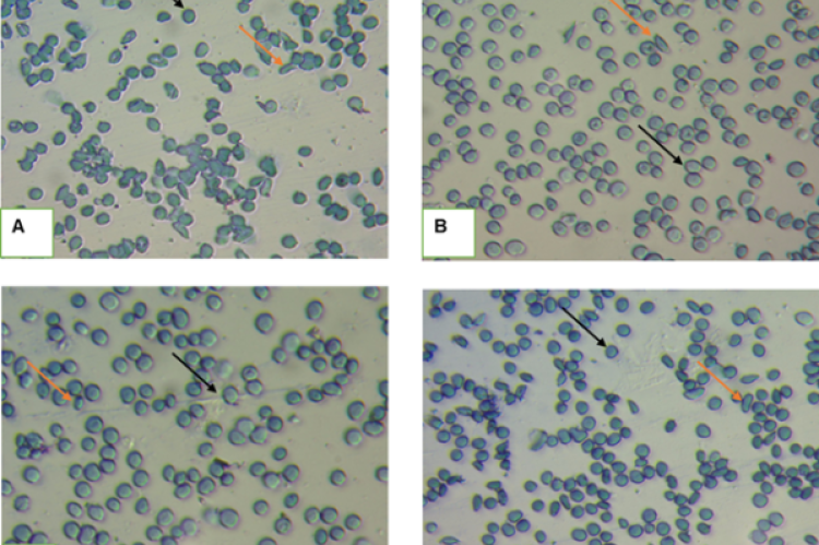 Photomicrographs of erythrocyte morphology under different treatments at 60th minute reading, Mag.x40. The sickled shape of red cells is illustrated by a yellow arrow, and normal RBCs by a black arrow. (A) - The reversal effect of NS on SS-RBC morphology. (B) - The reversal effect of PABA on SS-RBC morphology. (C) - The reversal effect of JCL 20 mg/mL on SS-RBC morphology. (D) - The reversal effect of JCS 20 mg/mL on SS-RBC morphology.