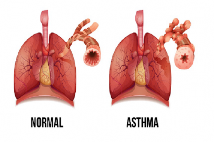 Symptoms of asthma.