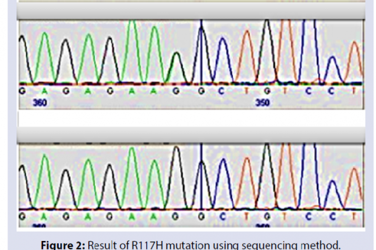 Result of R117H mutation using sequencing method.