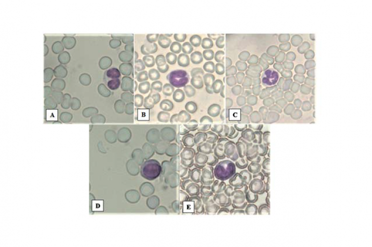 Observation of leukocyte types under a microscope with 100X magnification. A. Eosinophil, B. Banded neutrophil, C. Segmented neutrophil, D. Lymphocyte, E. Monocyte.