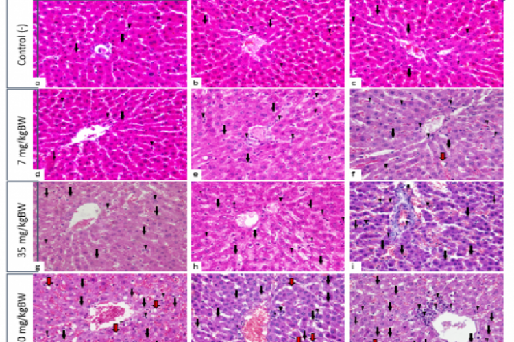 Histopathology of the liver. Description: necrosis (black arrow), inflammation (arrowhead), steatosis (red arrow). Figure 3: