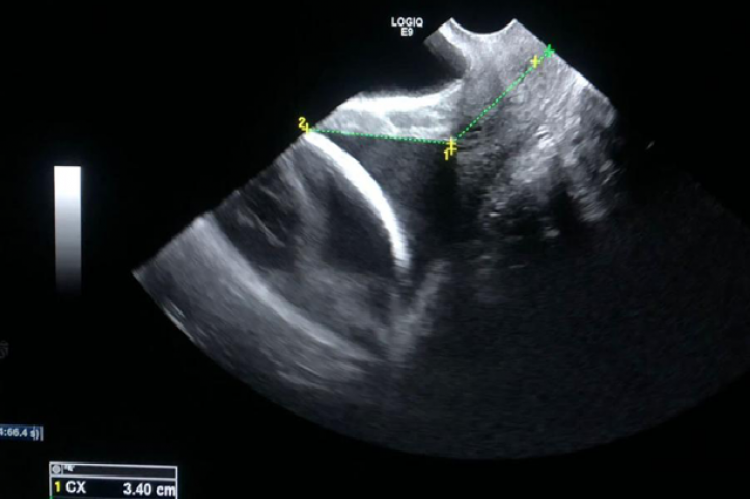 Anterior UCA by TVS.