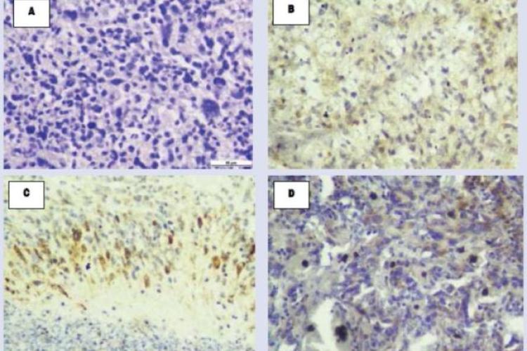 HIF-1α expression in the nuclei of tumor cells (magnification: 400x)