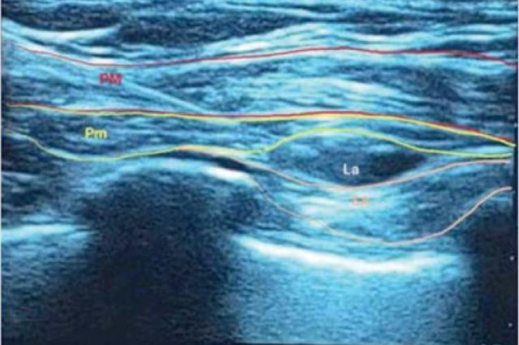 PM: Pectoralis Mayor, Pm: Pectoralis Minor, SA: Seratus Anterior, LA: Local Anestesi.