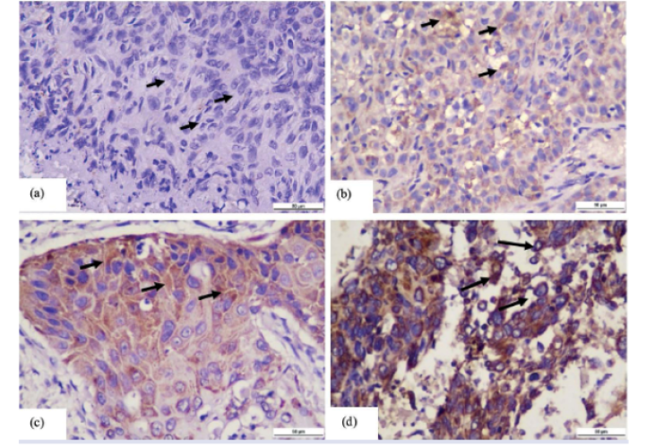 N-cadherin expression at various intensities (black arrow), 400x magnification. (a) N-cadherin is not expressed in N0 (IRS score 0), (b) weak intensity at stage N1 (IRS score 3), (c) moderate intensity at stage N2 (IRS score 6), (d) strong intensity at stage N2 (IRS score (9).