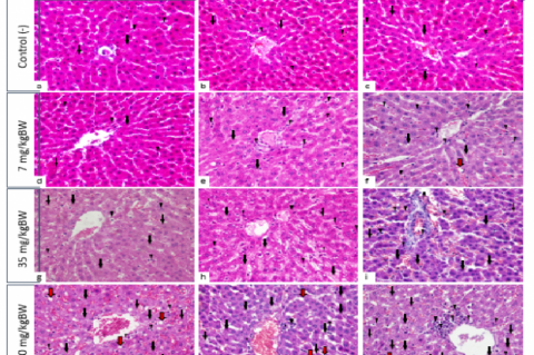 Histopathology of the liver. Description: necrosis (black arrow), inflammation (arrowhead), steatosis (red arrow). Figure 3: