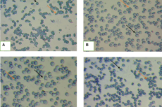 Photomicrographs of erythrocyte morphology under different treatments at 60th minute reading, Mag.x40. The sickled shape of red cells is illustrated by a yellow arrow, and normal RBCs by a black arrow. (A) - The reversal effect of NS on SS-RBC morphology. (B) - The reversal effect of PABA on SS-RBC morphology. (C) - The reversal effect of JCL 20 mg/mL on SS-RBC morphology. (D) - The reversal effect of JCS 20 mg/mL on SS-RBC morphology.