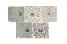 Observation of leukocyte types under a microscope with 100X magnification. A. Eosinophil, B. Banded neutrophil, C. Segmented neutrophil, D. Lymphocyte, E. Monocyte.